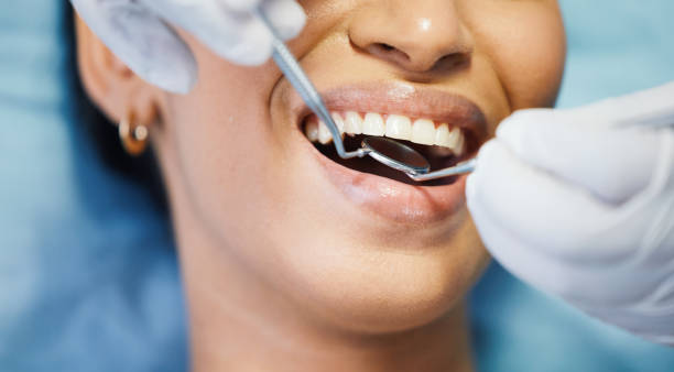 Best Emergency Wisdom Teeth Removal in Cedar Rapids, IA